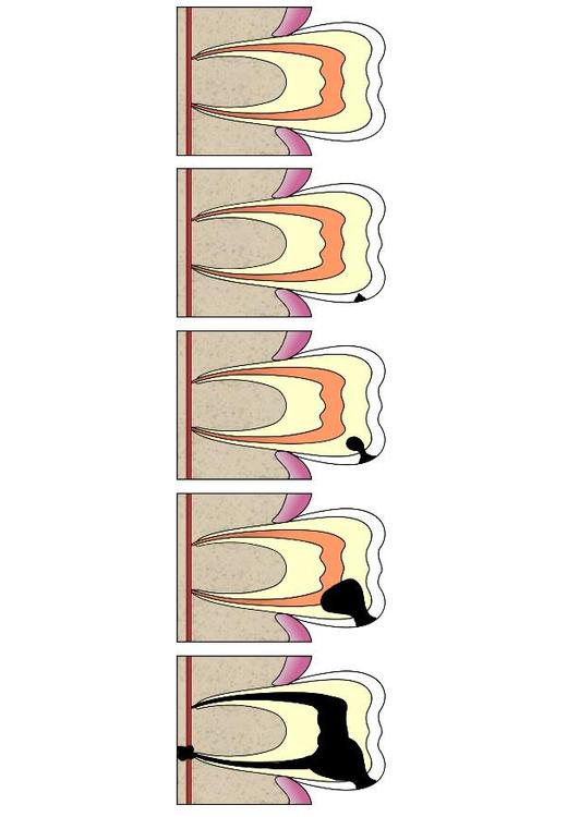 Entwicklung Zahnfäule