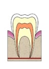 Entwicklung Zahnfäule 1