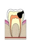 Entwicklung Zahnfäule 4