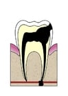 Entwicklung Zahnfäule 5